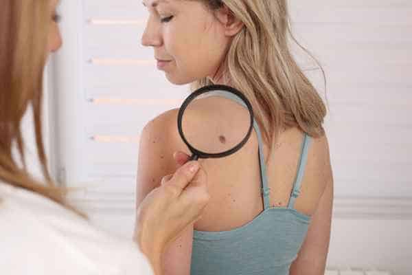 What Are Traditional Skin Lesion Removal Methods Cumbernauld?