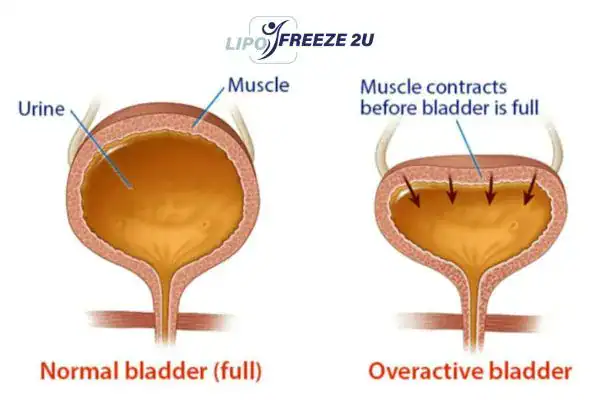 diagram of overactive bladder treatment Cumbernauld
