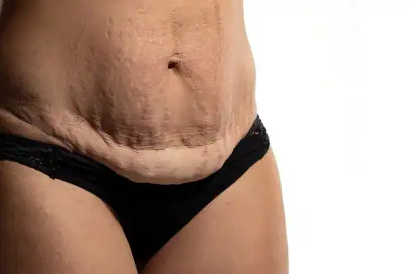 loose skin after weight loss injections Cumbernauld