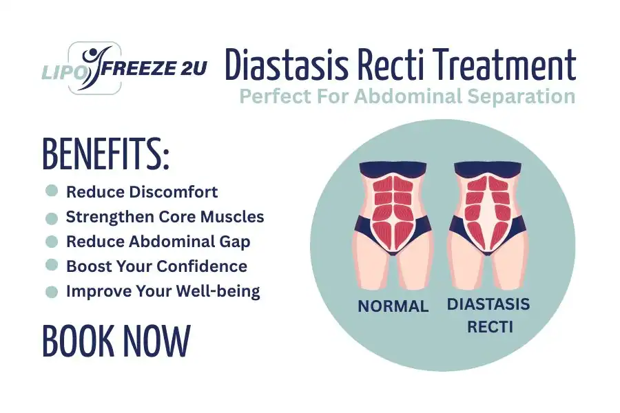 Benefits of body toning treatment Cumbernauld for Diastasis recti