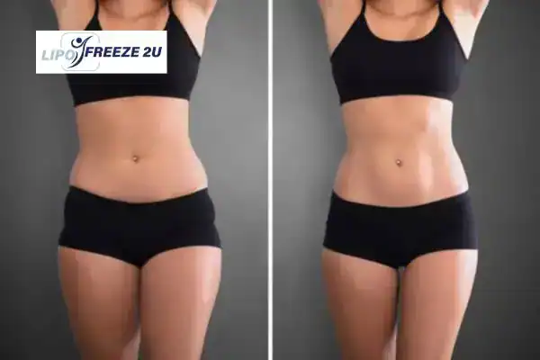How Can LIPO FREEZE 2U Support Your Post-Pregnancy Body Recovery Cumbernauld?
