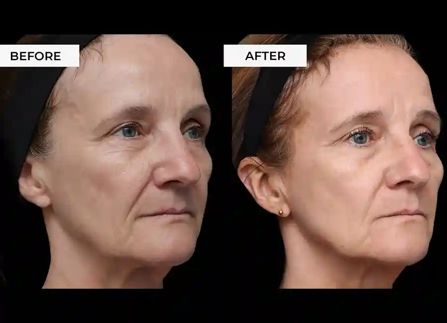 How Many RF Microneedling Sessions Will You Need to See a Difference Cumbernauld?