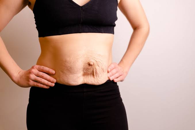 Is Surgery Really the Only Way to Repair Diastasis Recti Cumbernauld?