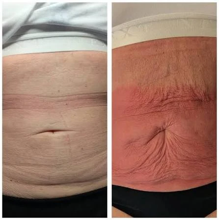 How Does RF Microneedling Improve Crepey, Thin and Uneven Skin Texture Cumbernauld?