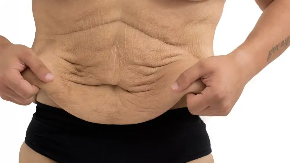 Why Does Weight Loss Medication Leave Some People With Loose or Sagging Skin Cumbernauld?